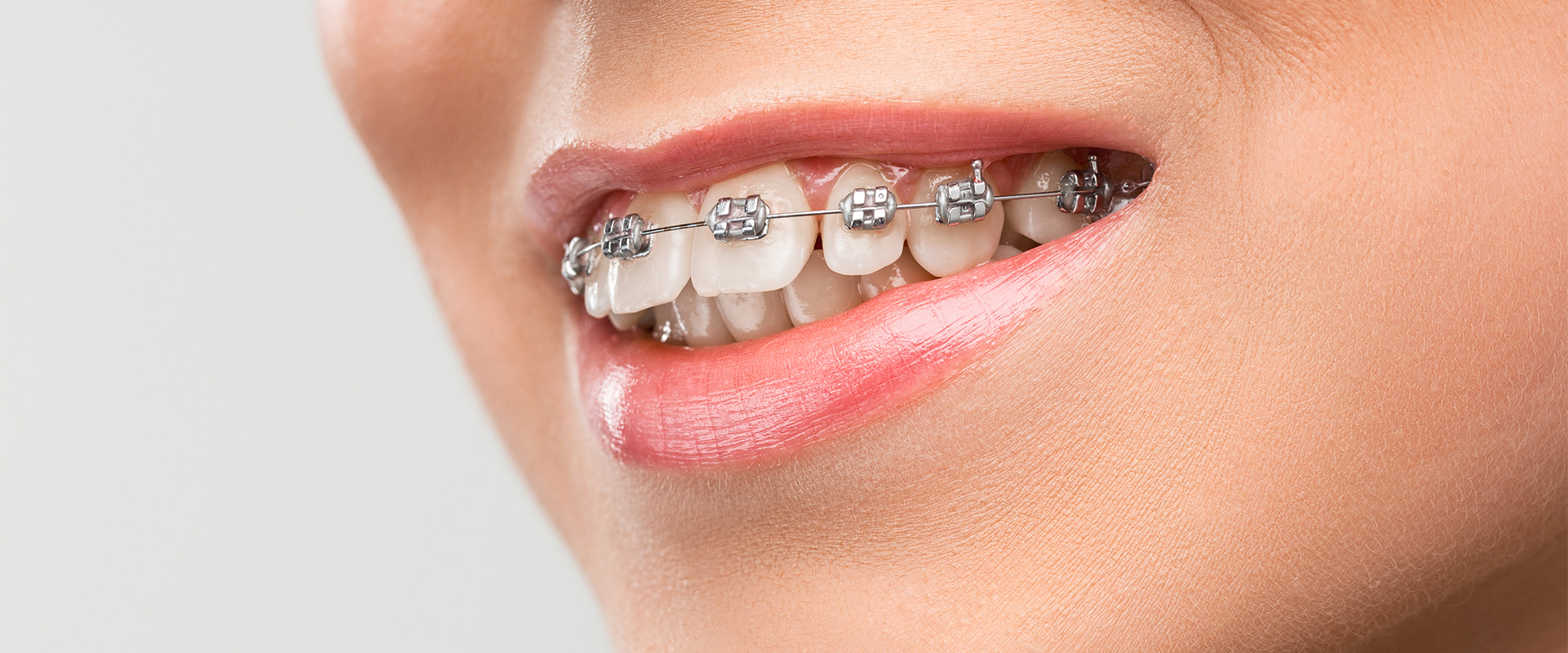 Diş Teli Tedavisi (Braket Çeşitleri)